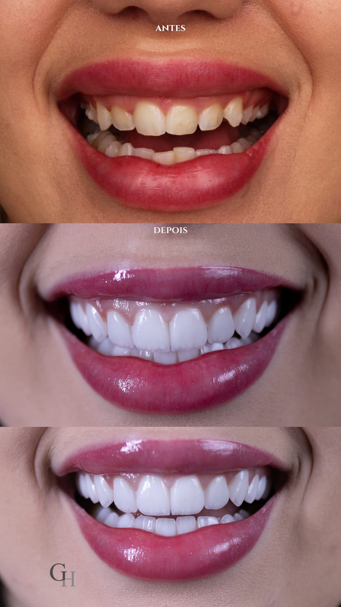 Antes e depois resultado procedimento estético bege minimalista post para instagram (Story).zip - 1